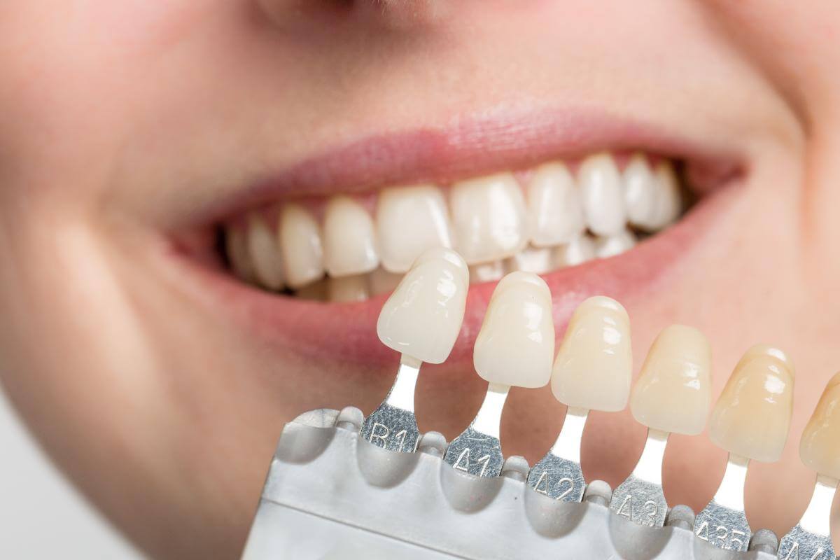 Dental Veneers